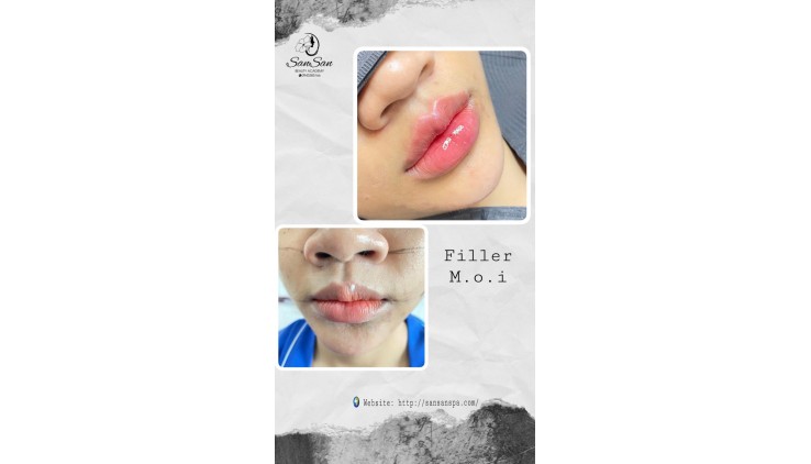 SAN SAN BEAUTY CHƯƠNG TRÌNH SIÊU ƯU ĐÃI DỊCH VỤ FILLER CHỈ CÒN 999K/1cc C.ấ.y Collagen HA chỉ #999k 1cc Địa chỉ: 137/1 Ngô Quyền, Phường 6, Quận 10.